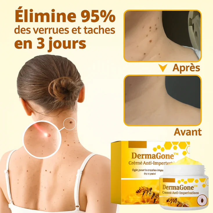 DermaGone™ Crème Anti-Imperfections | Élimine 95 % des verrues et taches en 3 jours!