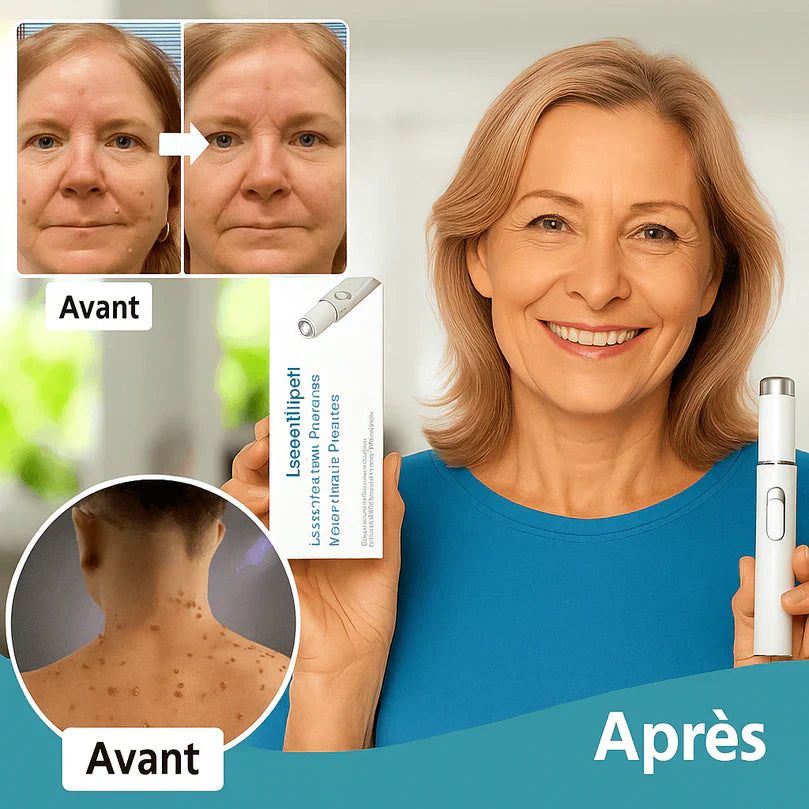 LaserWipe™ Stylo Anti-Verrues Haute Précision | Débarrassez-vous des verrues et taches en 48 h – sans cicatrice!